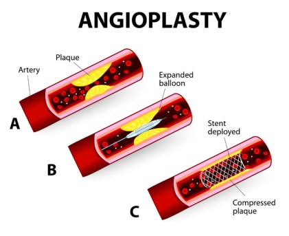 Coronary Angioplasty with Stent Placement by OrangeCountySurgeons 
